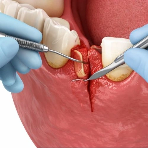 Surgical Gum Treatment (Only if Needed)